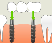 インプラント治療なら、顎の骨に直接人工歯根（インプラント体）を埋め込みますので、健康な歯を削りません。