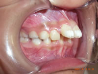 子供の不正咬合例１／上顎前突（出っ歯）